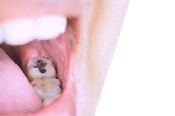 Are Dental Fillings For Kids Necessary?