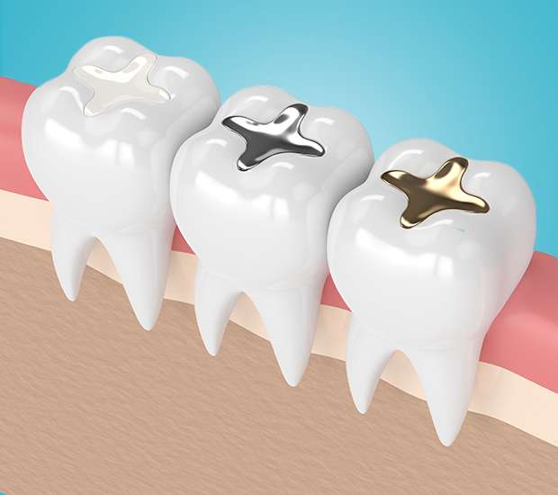 Richmond Tooth Colored Fillings