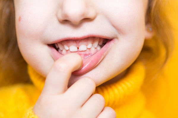 Dental Parkk - The Child Dentist - PERMANENT TREATMENT FOR SO CALLED TEMPORARY  TEETH. 4.5 year old came with a broken filling done somewhere else a year  back. She was told milk