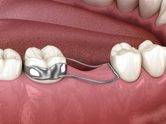 How Space Maintainers Get Patients Ready For Braces