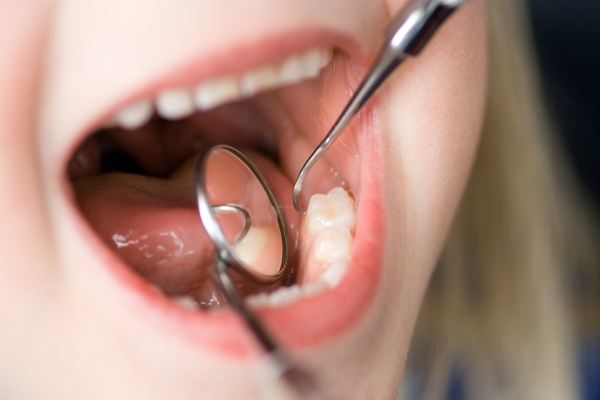 The ABCs Of Dental Fillings For Kids